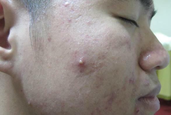 Điều cần biết khi điều trị mụn bọc có mủ mà bạn nên biết ngay