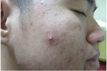 Điều cần biết khi điều trị mụn bọc có mủ mà bạn nên biết ngay