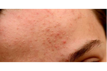 Điều trị mụn ẩn dưới da không quá khó