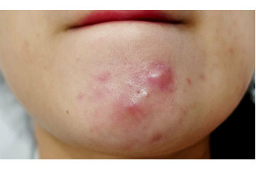Điều trị mụn bọc có mủ cho sinh viên ở đâu TPHCM?