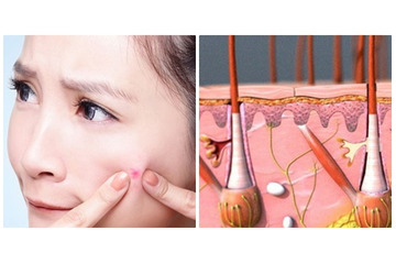 Điều trị mụn bọc tận gốc với những phương pháp siêu đơn giản