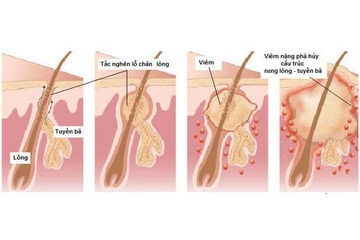 Điều trị mụn cho nam giới có khác với ở nữ giới không?