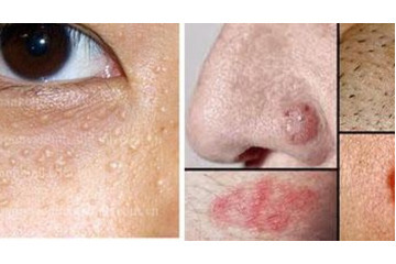 Điều trị mụn cóc trên mặt sao cho hiệu quả nhất?táo