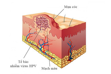 Điều trị mụn cóc với phương pháp từ dân gian