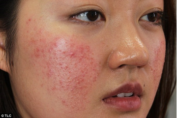 Điều trị mụn dị ứng như thế nào là tốt nhất?