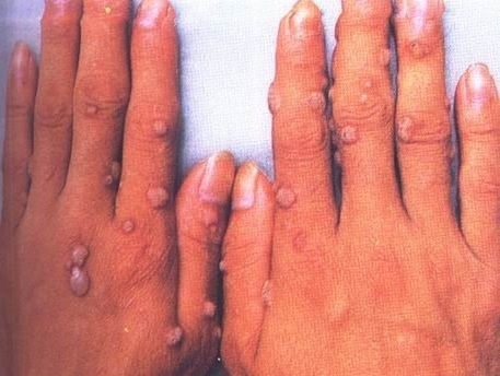 Điều trị mụn hạt cơm có khó không?