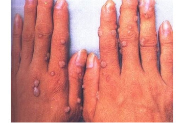 Điều trị mụn hạt cơm có khó không?