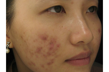 Điều trị mụn lâu năm tại đâu hiệu quả nhất?