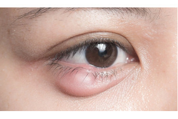 Điều trị mụn lẹo ở mắt như thế nào?