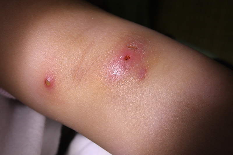 Điều trị mụn nhọt bằng cách nào?