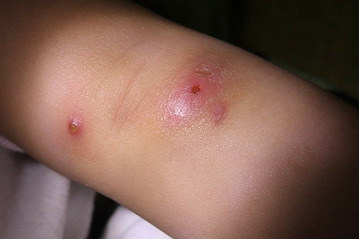 Điều trị mụn nhọt bằng cách nào?