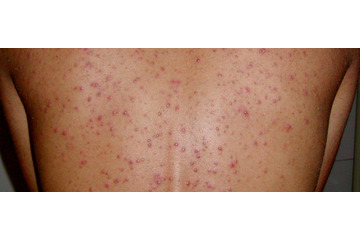 Điều trị mụn ở lưng sao cho hiệu quả?