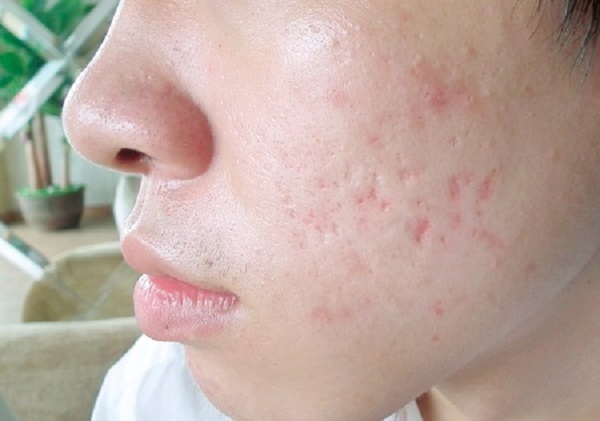 Điều trị mụn rỗ sao cho tốt nhất