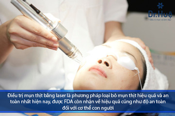 Điều Trị Mụn Thịt Bằng Tia Laser Có Hiệu Quả Không