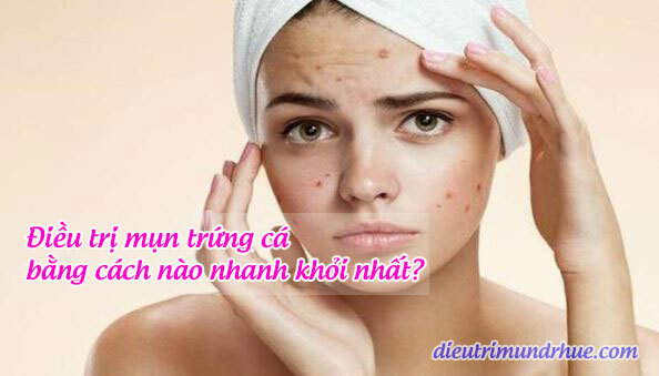 Điều trị mụn trứng cá bằng cách nào nhanh khỏi nhất?