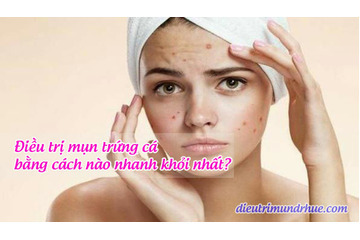 Điều trị mụn trứng cá bằng cách nào nhanh khỏi nhất?
