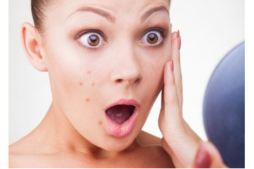 Điều trị mụn trứng cá sao cho hiệu quả nhất?