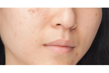 Điều trị sẹo lõm bằng kim lăn có đắt không?