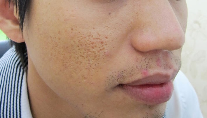 Điều trị sẹo lõm cho nam giới tại đâu?