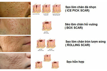 Điều trị sẹo lõm ở đâu là tốt nhất tại Tp. HCM?