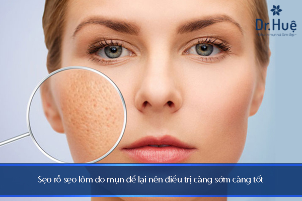 Điều Trị Sẹo Lõm Sẹo Rỗ Do Mụn An Toàn Hiệu Quả Tại Dr.Huệ