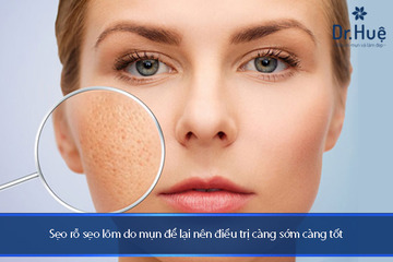 Điều Trị Sẹo Lõm Sẹo Rỗ Do Mụn An Toàn Hiệu Quả Tại Dr.Huệ