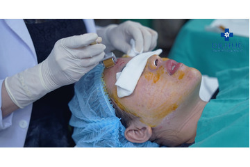 Điều trị sẹo lõm siêu hiệu quả bằng lăn kim