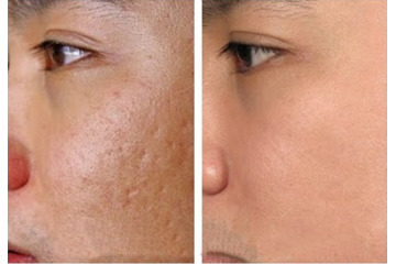 Điều trị sẹo rỗ bằng laser có gì hot?