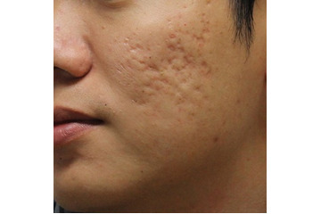 Điều trị sẹo rỗ bằng laser có thực sự tốt?