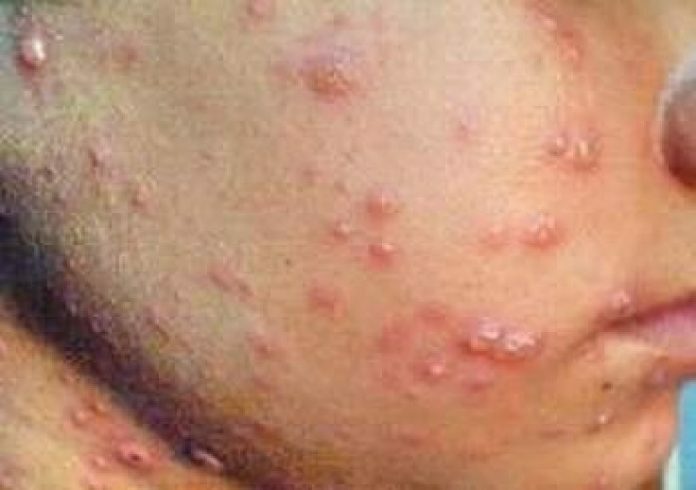 Điều trị sẹo rỗ ở đâu mới tốt? - Điều trị mụn Dr Huệ - Hình 1