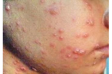 Điều trị sẹo rỗ ở đâu mới tốt?