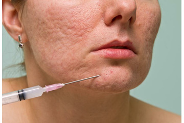 Điều trị sẹo rỗ sau mụn có dễ không?