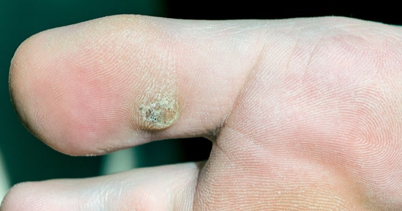 Đốt mụn cơm bằng laser ở đâu tốt nhất, giá bao nhiêu tiền