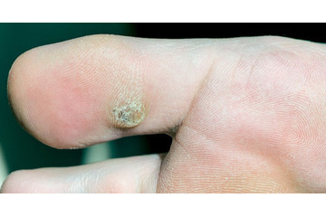 Đốt mụn cơm bằng laser ở đâu tốt nhất, giá bao nhiêu tiền