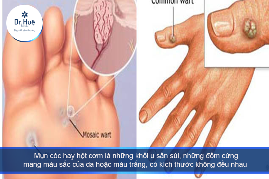 Mụn cơm là gì ?