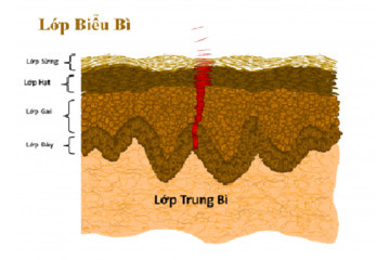 Giá điều trị sẹo lõm bằng kim lăn tại Dr Huệ là bao nhiêu?