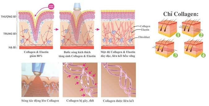 Giá điều trị sẹo lõm bằng kim lăn tại Dr Huệ là bao nhiêu? - Điều trị mụn Dr Huệ - Hình 5
