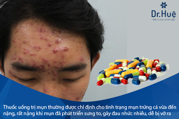 Giải Đáp: Bị Mụn Trứng Cá Nên Uống Thuốc Gì Là Hiệu Quả Nhất