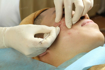 [Giải Đáp] Đi nặn mụn ở spa có bị lây bệnh không?