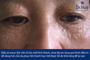 Giải Đáp: Đốt Mụn Thịt Có Để Lại Sẹo Không?