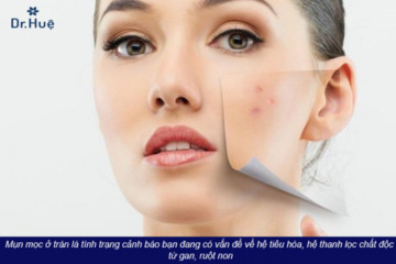 [Giải Đáp] Những vị trí mọc mụn trên mặt nói lên điều gì