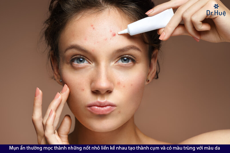 [Giải Đáp] Tại sao mụn ẩn mãi không hết và nên làm gì