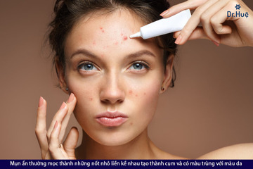 [Giải Đáp] Tại sao mụn ẩn mãi không hết và nên làm gì