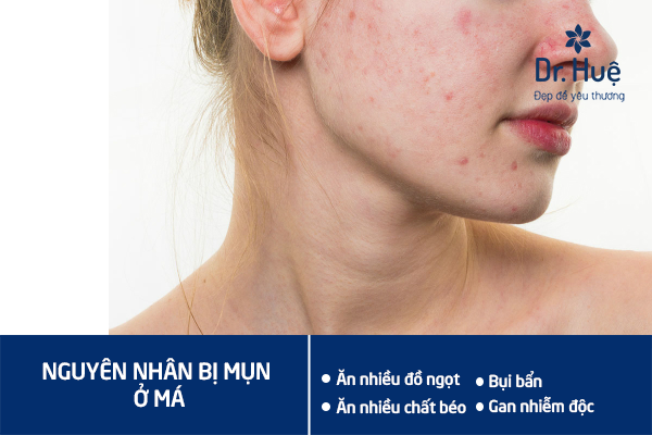 [Giải Đáp] Vị trí mọc mụn trên mặt nói lên điều gì?