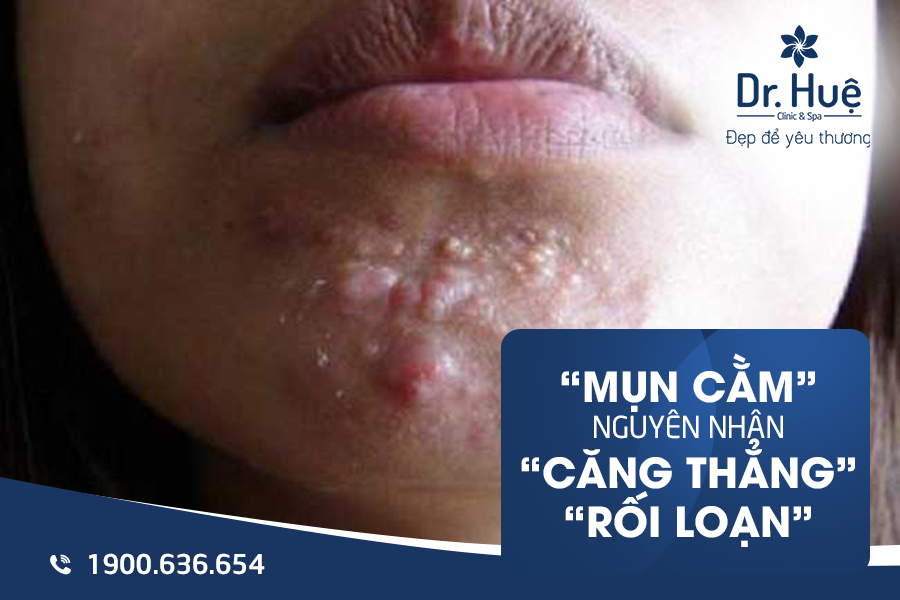 Mụn mọc ở cằm