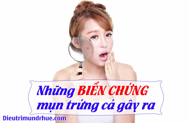 Giật mình với những biến chứng mụn trứng cá gây ra