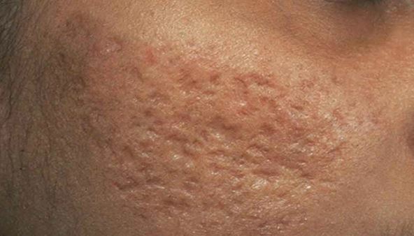 Giật mình với những biến chứng mụn trứng cá gây ra - Điều trị mụn Dr Huệ - Hình 2