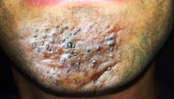 Giật mình với những biến chứng mụn trứng cá gây ra - Điều trị mụn Dr Huệ - Hình 3