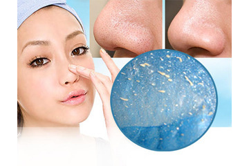 Giúp bạn trả lời câu hỏi điều trị mụn có ảnh hưởng tới sức khỏe không?