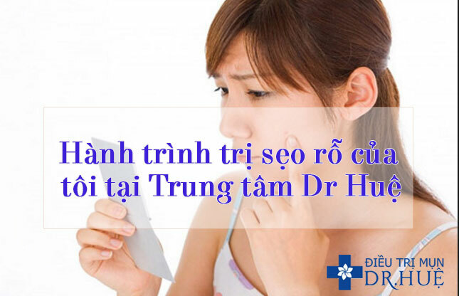 Hành trình trị sẹo rỗ của tôi tại Trung tâm Dr. Huệ